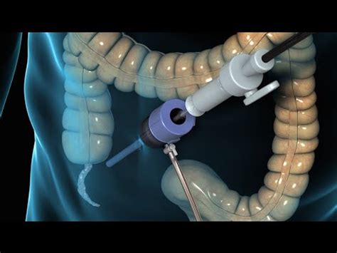 Minimally Invasive Relief: Understanding the Benefits of Appendix Operation by Laparoscopy