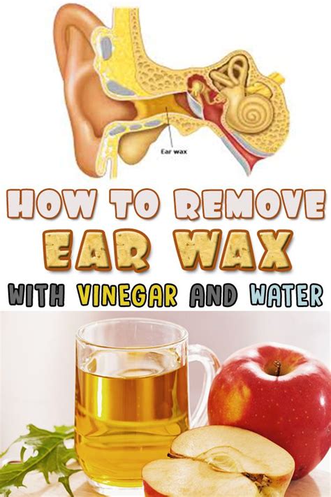 aahowtoremoveearwaxwithvinegarandwater Ear wax, Impacted ear