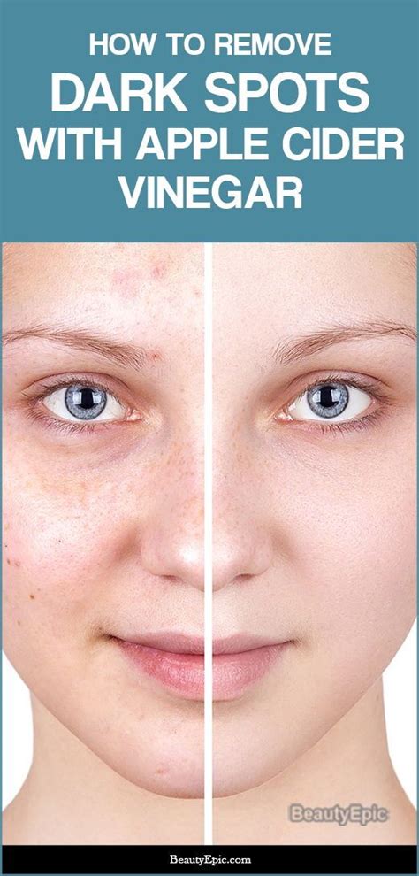 How To Use Apple Cider Vinegar For ACNE Fast Health Fitness