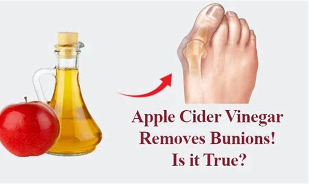 Apple Cider Vinegar Removes Bunions