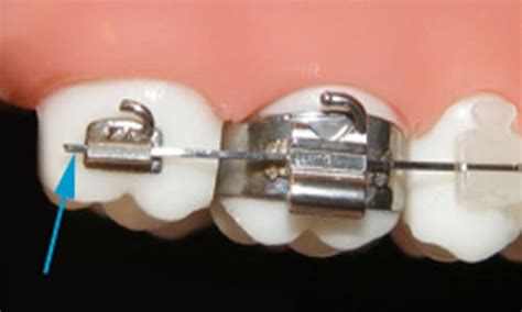 Archwire Popped Out Bracket