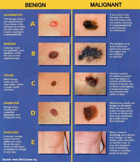 are all black spots melanoma