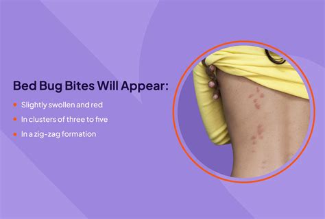 are bed bug bites hard or soft