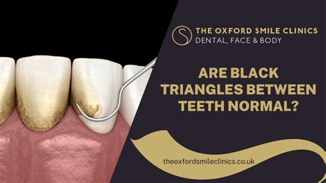 Are Black Triangles Between Teeth Normal