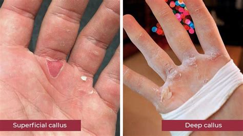 Are Calluses From Lifting Bad