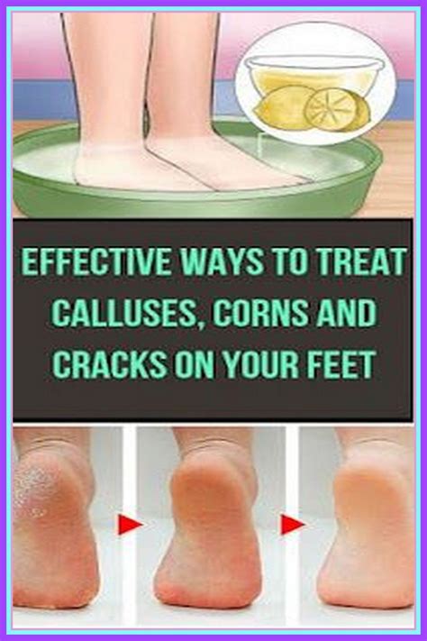 Are Calluses Healthy