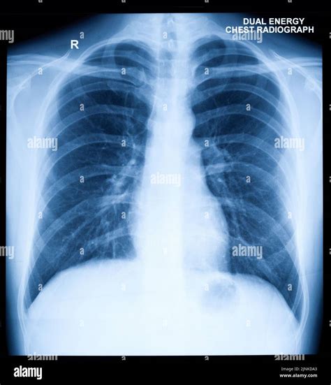 Are Chest X Rays Expensive