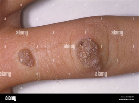 are common warts caused by hpv