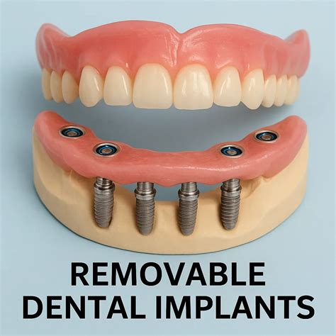 Are Dental Implants Removable