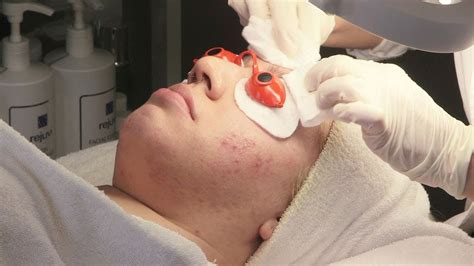 Are Facials Good for Acne? Exploring the Benefits of Professional Skin Treatments