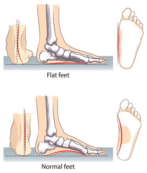 Are Flat Feet Inherited