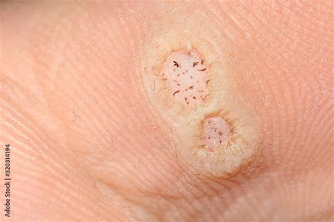 are foot warts because of hpv