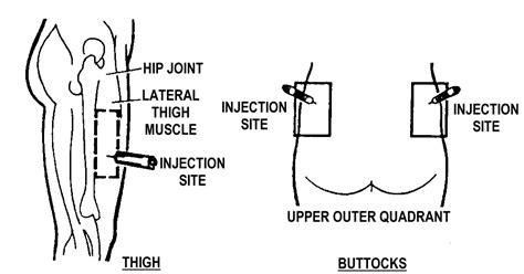 Are Quad Injections Safe