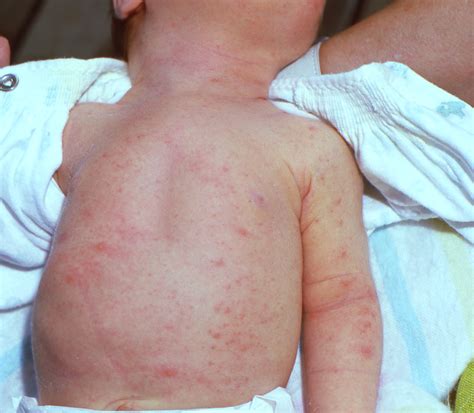 Are Rashes Normal On Newborns