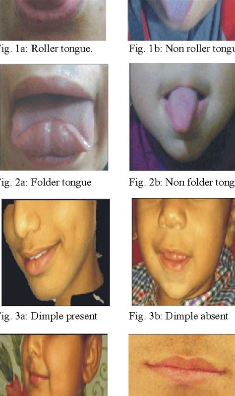 are rolling and folding tongues abnormalities