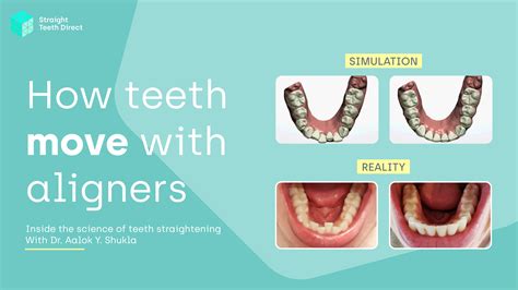 Are Teeth Aligners Good