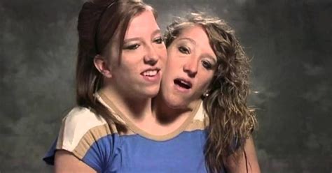 are the conjoined hensel twins still living