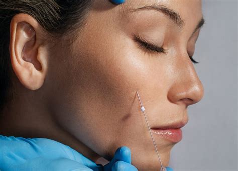 Are Thread Lifts Bad