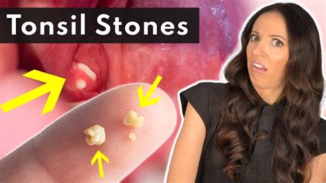 are tonsil stones hard or soft