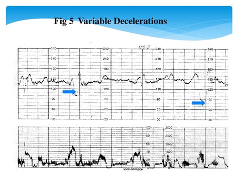 are variable decelerations normal