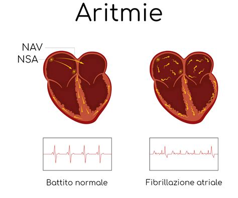 aritmia cardiaca cause e rimedi