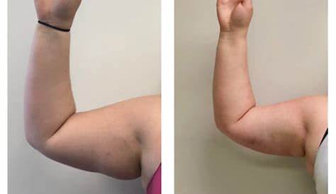 Arm Fat Cavitation Treatments Ultrasonic Loss Slimming & Beauty Clinic