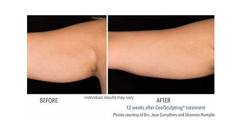 Arm Fat Freezing Before And After How To Lose In A Week