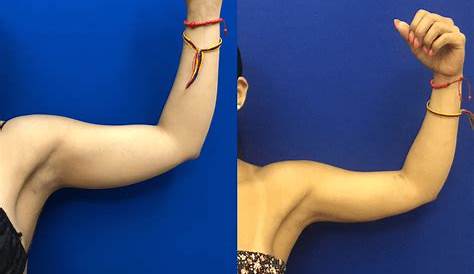 Arm Fat Lipo Before And After suction s