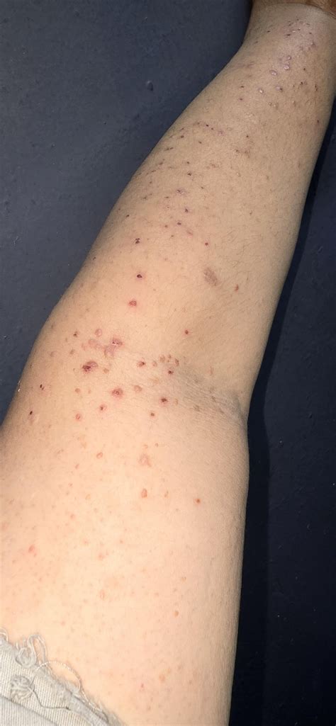 Arm Acne Marks