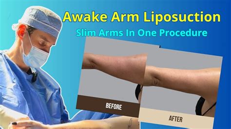 Arm Fat Transfer