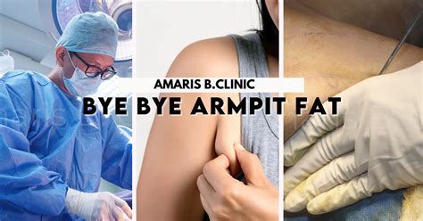Armpit Fat Removal Injection