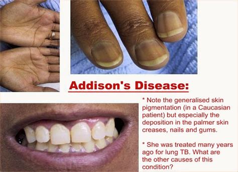 arnaldia disease