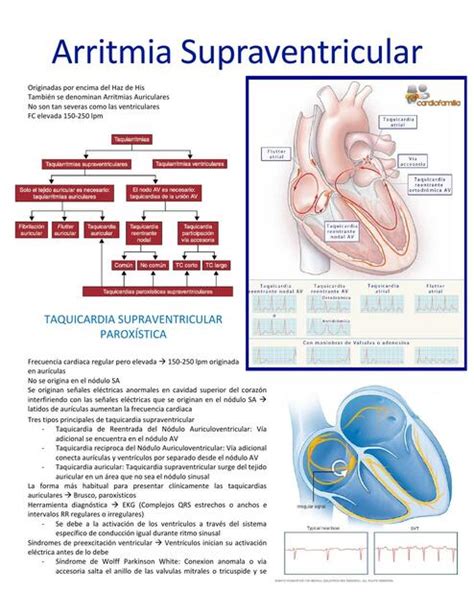 arritmia supraventricular cie10