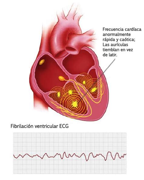 arritmia ventricular cid 10