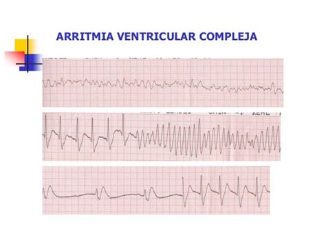arritmia ventricular compleja