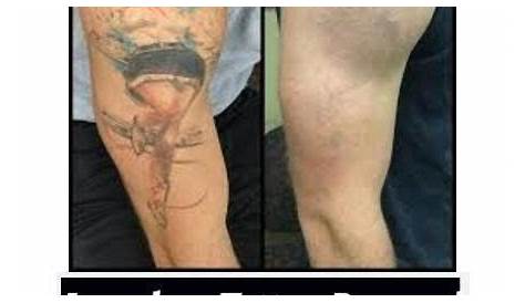 Art Tattoo Removal Near Me Laser In Chandler AZ Free Consultation —