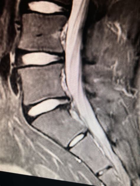 Arthritis Back Reddit