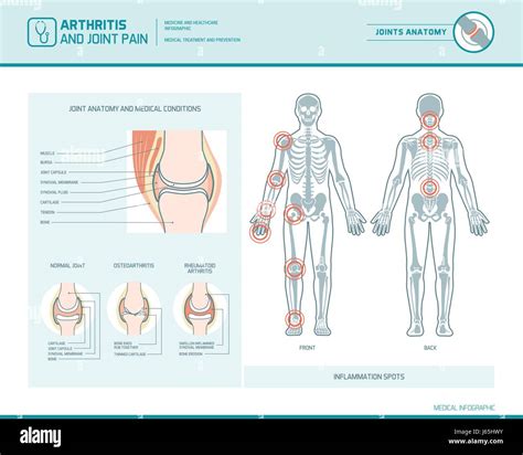 Arthritis Background Information