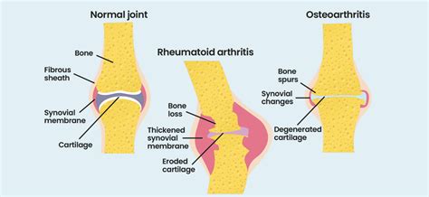 Arthritis Explanation