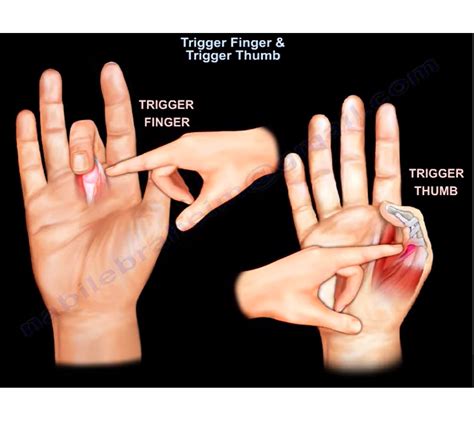 Arthritis Or Trigger Finger 