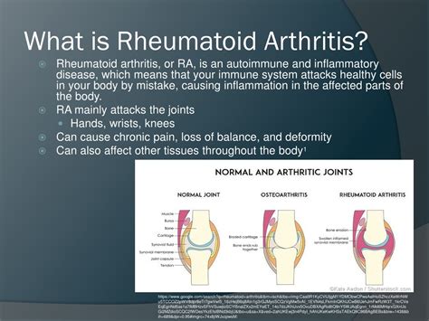 Arthritis Term Definition