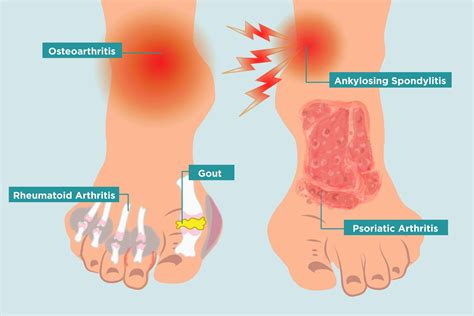 Arthritis Under Feet