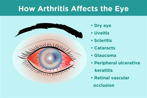 Arthritis Vision Problems