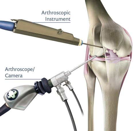 Recover Faster with Arthroscopic Surgery Knee Procedure Insights