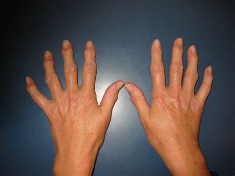 arthrose in hand und fingern