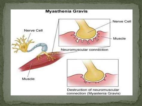 articles on myasthenia gravis