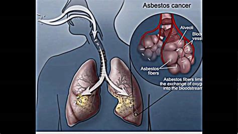 asbestos and lung cancers