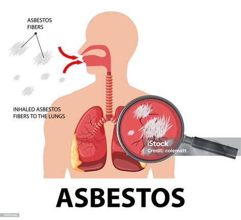 Asbestosis Respiratory Disease caused by Asbestos Fibers