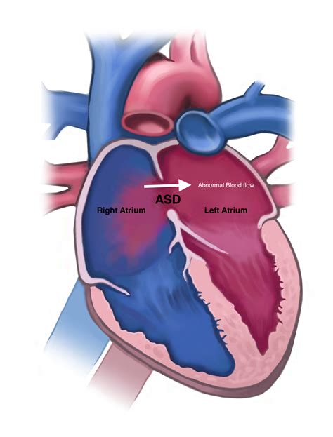 Understanding ASDs Heart Defect: Causes, Symptoms, and Treatments
