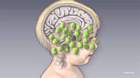 aseptic meningitis mayo clinic